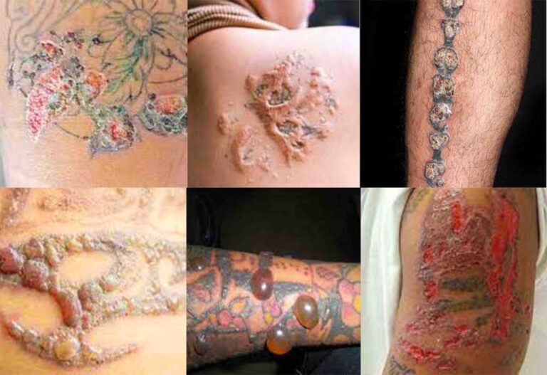 What are the negative effects on the body due to the design of tattoo?